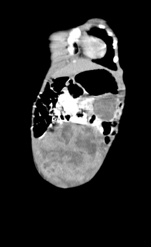 Abdominopelvic rhabdomyosarcoma (Radiopaedia 78356-90984 Coronal C+ portal venous phase 13).jpg