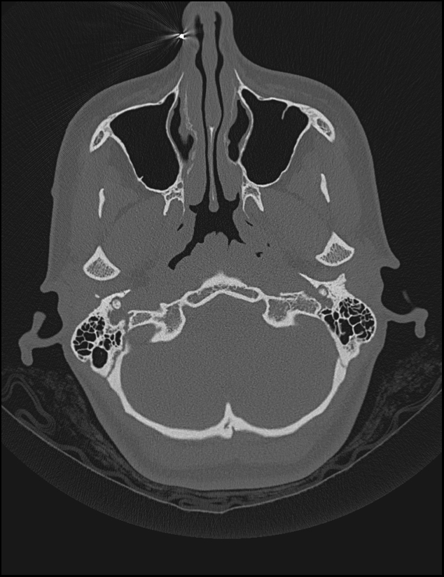 Aberrant right internal carotid artery (Radiopaedia 65191-74198 Axial non-contrast 19).jpg