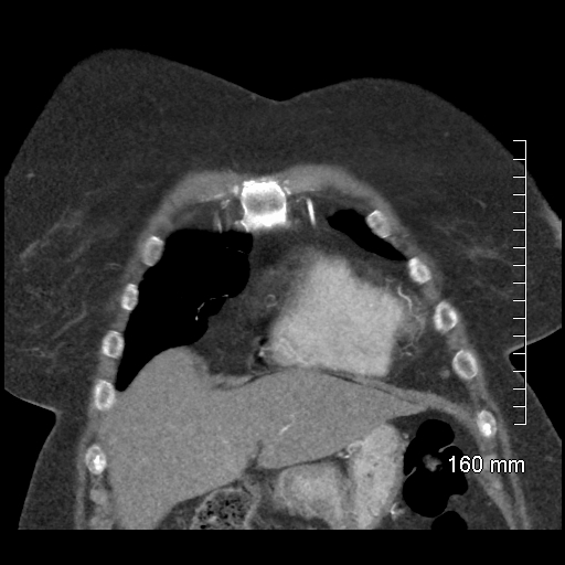 File:Aberrant right subclavian artery stenosis (Radiopaedia 52656-58670 B 22).jpg