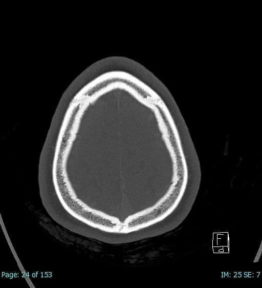 Abscess of the pinna (Radiopaedia 68868-78598 Axial bone window 2).jpg