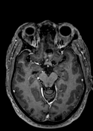 Accessory middle cerebral artery (Radiopaedia 73114-83828 Axial T1 C+ 71).jpg