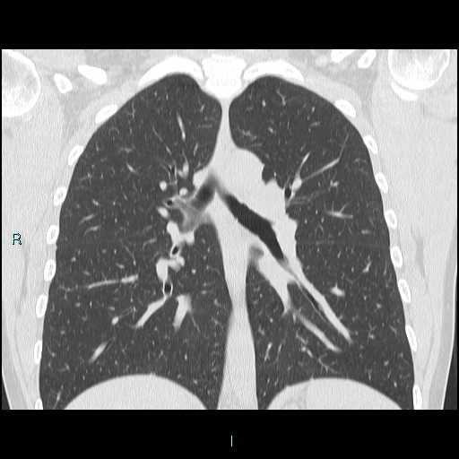 Accidental foreign body aspiration (seamstress needle) (Radiopaedia 77740-89983 Coronal lung window 25).jpg
