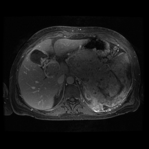 Acinar cell carcinoma of the pancreas (Radiopaedia 75442-86668 Axial T1 C+ fat sat 85).jpg