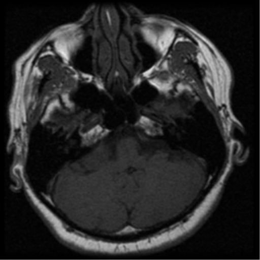 File:Acoustic schwannoma (Radiopaedia 33045-34060 Axial T1 6).png