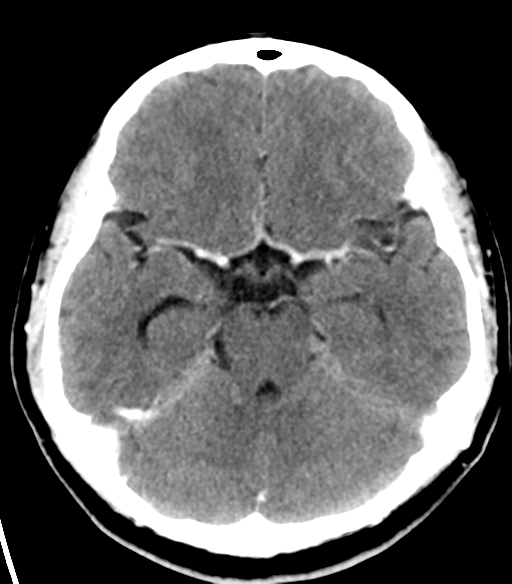 File:Acoustic schwannoma (Radiopaedia 33045-34065 Axial C+ delayed 9).png