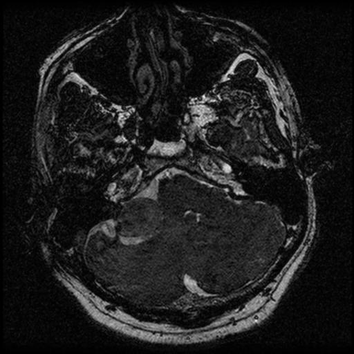 File:Acoustic schwannoma (Radiopaedia 39170-41387 Axial FIESTA 52).png