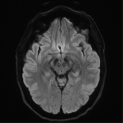 Acoustic schwannoma (Radiopaedia 50846-56358 Axial DWI 40).png