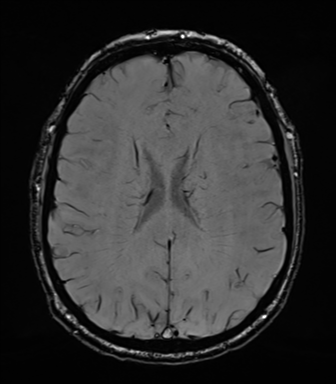 Acoustic schwannoma (Radiopaedia 50846-56358 Axial SWI 59).png