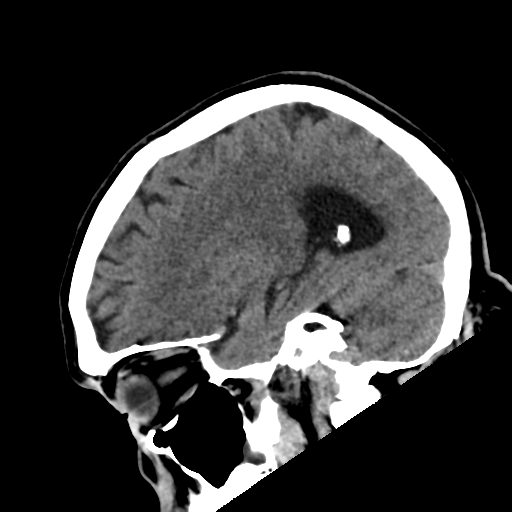 File:Acoustic schwannoma (Radiopaedia 55729-62280 Sagittal non-contrast 11).png