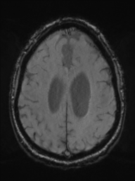 Acoustic schwannoma (Radiopaedia 55729-62281 Axial SWI 38).png