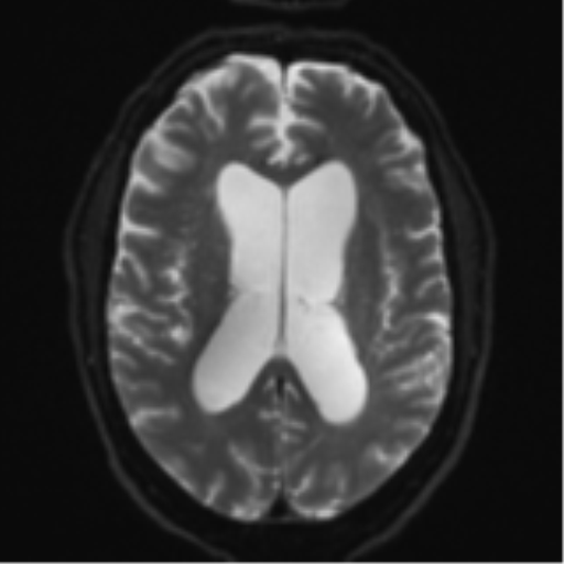 File:Acoustic schwannoma (Radiopaedia 55729-62281 E 16).png