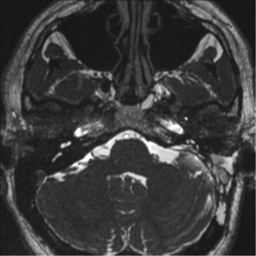 Acoustic schwannoma (translabyrinthine resection) (Radiopaedia 43570-46972 Axial CISS 22).png