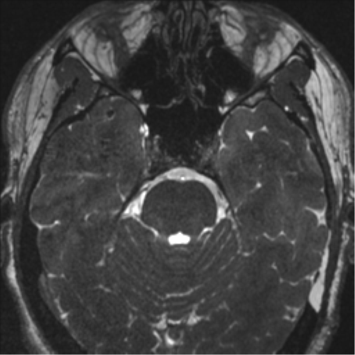 Acoustic schwannoma (translabyrinthine resection) (Radiopaedia 43570-46972 Axial CISS 46).png