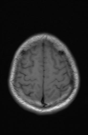 Acoustic schwannoma - probable (Radiopaedia 20386-20292 Axial T1 16).jpg