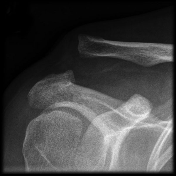 File:Acromioclavicular joint injury (type III) (Radiopaedia 5842).jpg