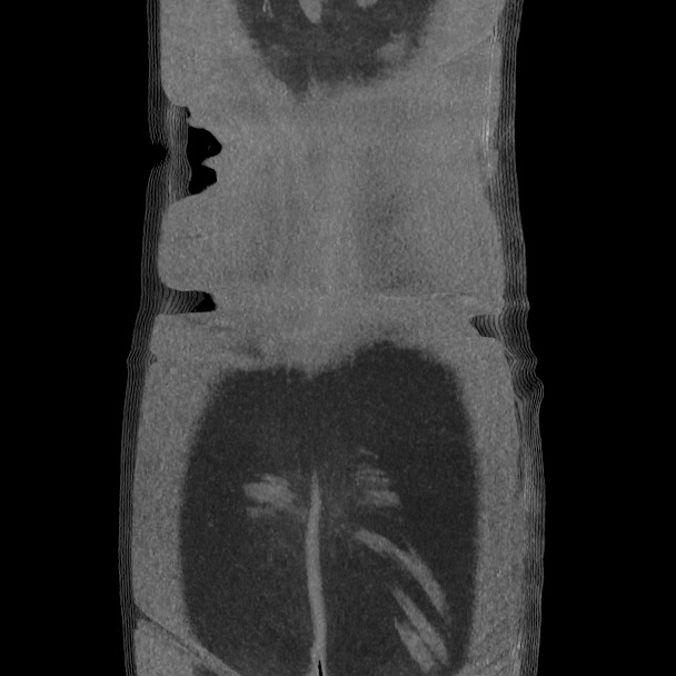 Active colonic bleed on CT (Radiopaedia 49765-55025 Coronal art MIP 60).jpg