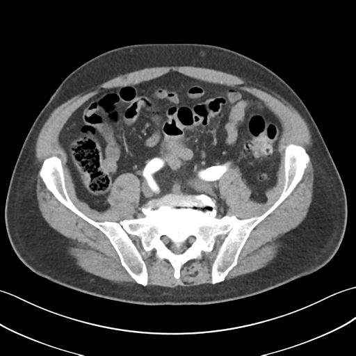 File:Active diverticular hemorrhage (Radiopaedia 39415-41725 Axial C+ arterial phase 47).png