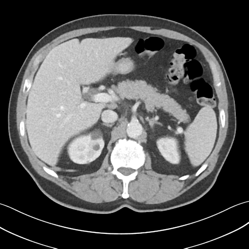 File:Active diverticular hemorrhage (Radiopaedia 39415-41725 Axial C+ portal venous phase 18).png