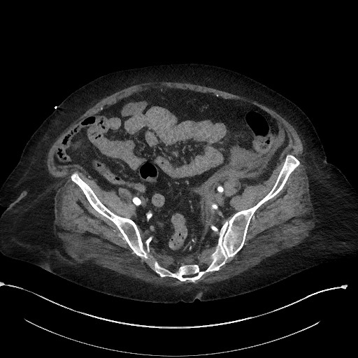 File:Active renal extravasation with large subcapsular and retroperitoneal hemorrhage (Radiopaedia 60975-68796 Axial C+ arterial phase 151).jpg
