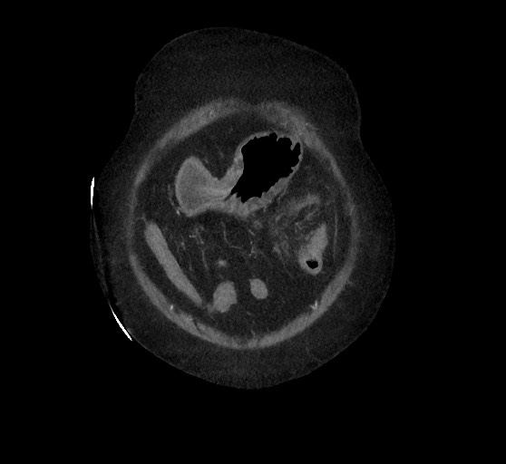 Active renal extravasation with large subcapsular and retroperitoneal hemorrhage (Radiopaedia 60975-68796 Coronal C+ arterial phase 26).jpg