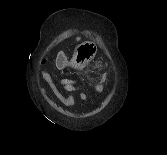 Active renal extravasation with large subcapsular and retroperitoneal hemorrhage (Radiopaedia 60975-68796 Coronal C+ portal venous phase 29).jpg