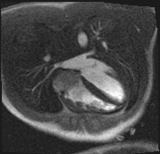 Active right ventricular cardiac sarcoidosis (Radiopaedia 55596-62100 Axial Dynamic perfusion scan MOCO 64).jpg