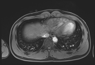 Active right ventricular cardiac sarcoidosis (Radiopaedia 55596-62100 Axial Post contrast Dixon 61).jpg