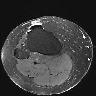 File:Acute-on-chronic transient lateral patellar dislocation with trochlear dysplasia (Radiopaedia 84099-99349 Axial PD fat sat 32).jpg