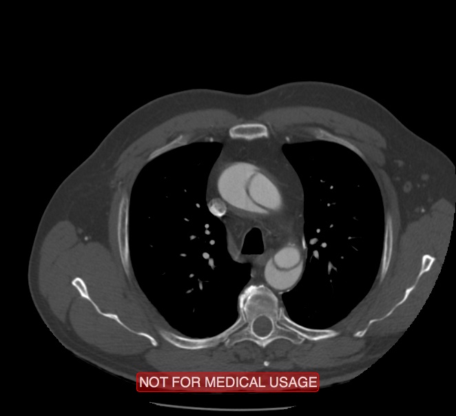 Acute aortic dissection - Stanford type A (Radiopaedia 40661-43285 Axial C+ arterial phase 12).jpg