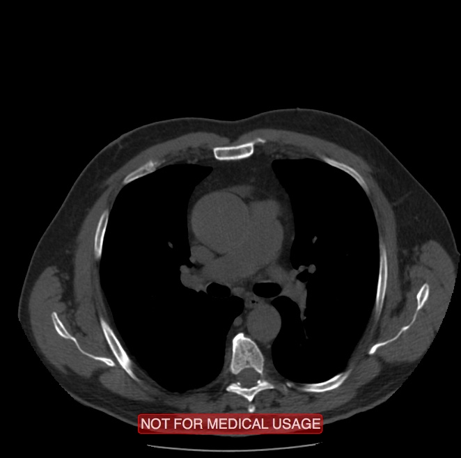 Acute aortic dissection - Stanford type A (Radiopaedia 40661-43285 Axial non-contrast 21).jpg