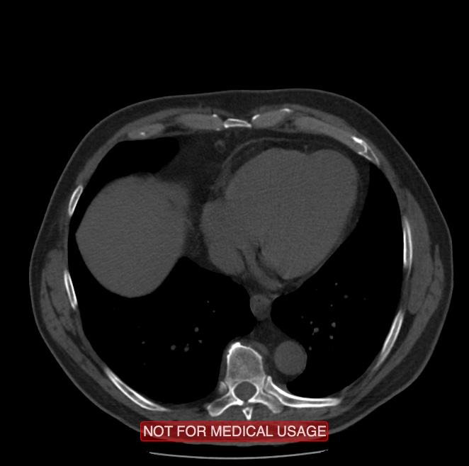 Acute aortic dissection - Stanford type A (Radiopaedia 40661-43285 Axial non-contrast 49).jpg