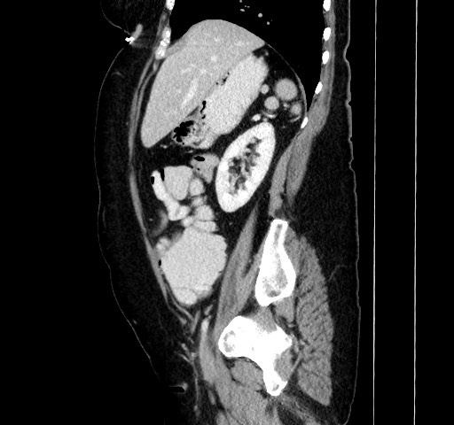 Acute appendicitis, heterotaxy syndrome (Radiopaedia 66884-76202 Sagittal C+ portal venous phase 47).jpg