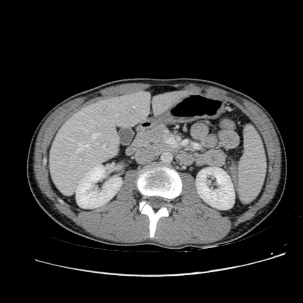 Acute appendicitis (Radiopaedia 27049-27227 Axial C+ portal venous phase 28).jpg