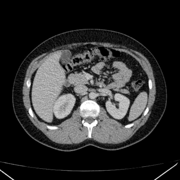 Acute appendicitis (Radiopaedia 38255-40270 Axial C+ portal venous phase 37).jpg