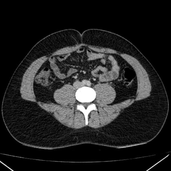 Acute appendicitis (Radiopaedia 38255-40270 Axial C+ portal venous phase 65).jpg