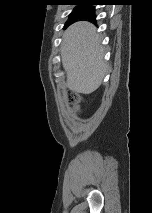 Acute appendicitis (Radiopaedia 48511-53463 Sagittal C+ portal venous phase 25).jpg