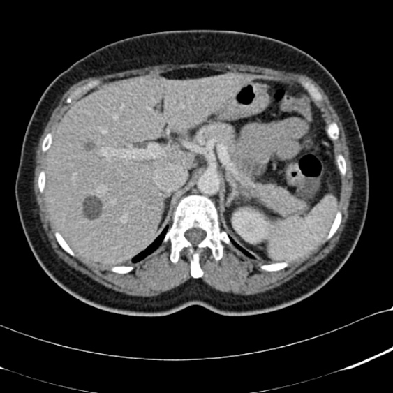 File:Acute appendicitis (Radiopaedia 48792-53822 Axial C+ portal venous phase 28).jpg