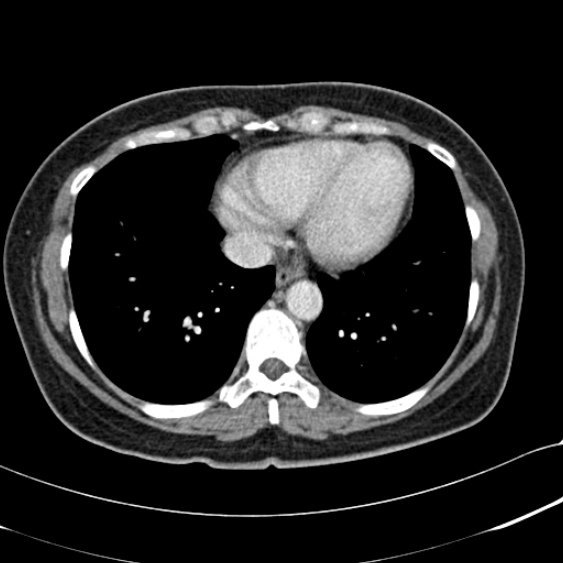 File:Acute appendicitis (Radiopaedia 48792-53822 Axial C+ portal venous phase 4).jpg