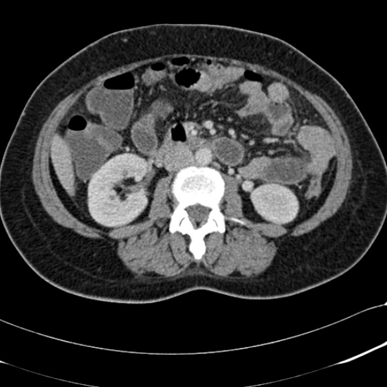 Acute appendicitis (Radiopaedia 48792-53822 Axial C+ portal venous phase 55).jpg