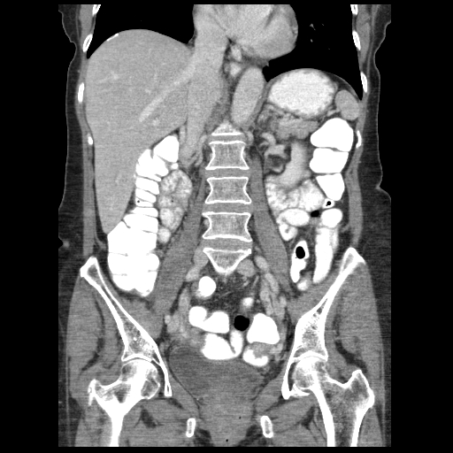 Acute appendicitis (Radiopaedia 52672-58589 Coronal C+ portal venous phase 64).jpg