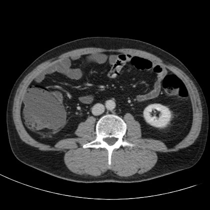 Acute appendicitis (Radiopaedia 66513-75790 Axial C+ portal venous phase 42).jpg