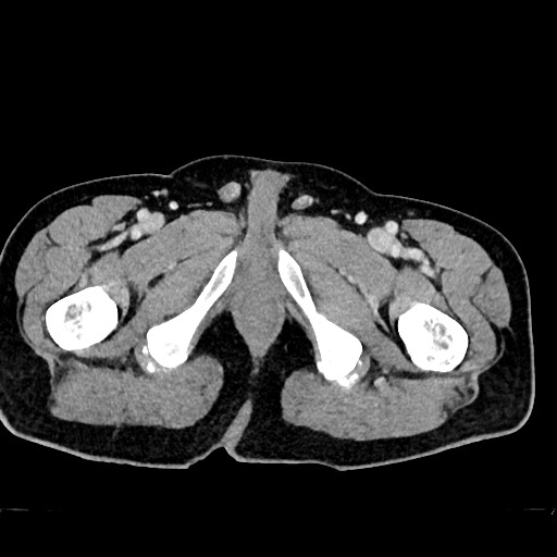 File:Acute appendicitis (Radiopaedia 77016-88960 Axial C+ portal venous phase 153).jpg