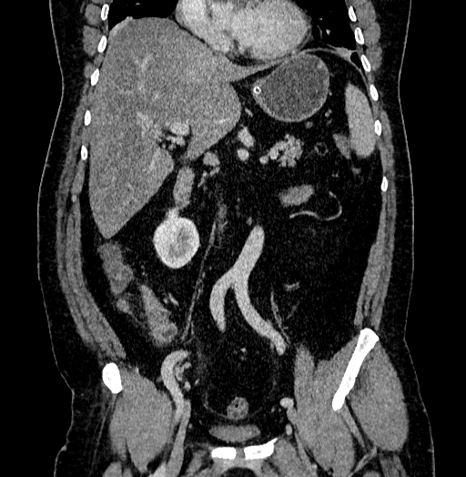 Acute appendicitis (Radiopaedia 79950-93224 Coronal C+ portal venous phase 45).jpg