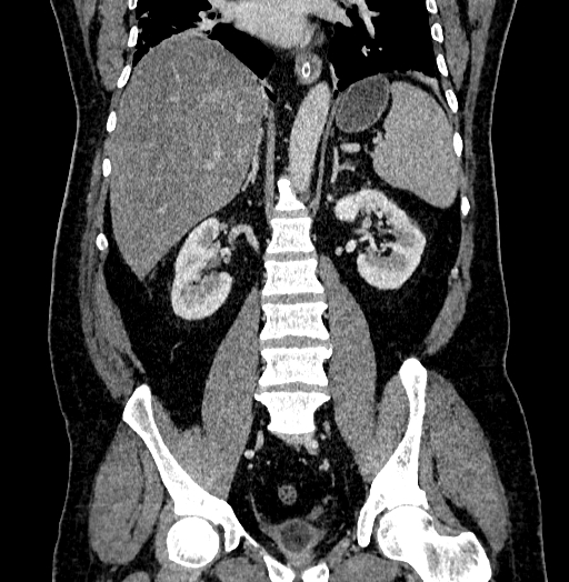 File:Acute appendicitis (Radiopaedia 79950-93224 Coronal C+ portal venous phase 58).jpg