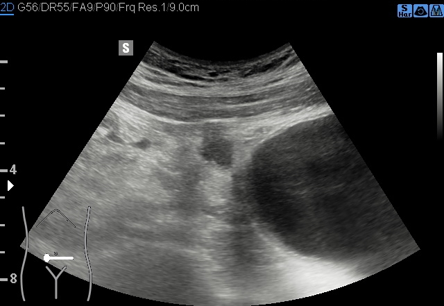 File:Acute appendicitis (Radiopaedia 85193-100745 B 144).jpg