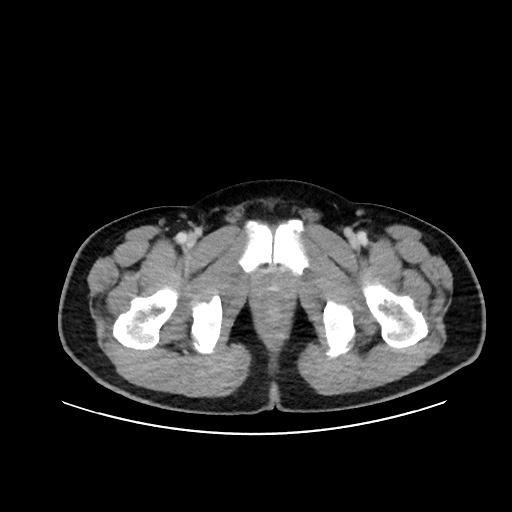 File:Acute appendicitis and COVID 19 pneumonia (Radiopaedia 76604-88380 Axial C+ portal venous phase 87).jpg