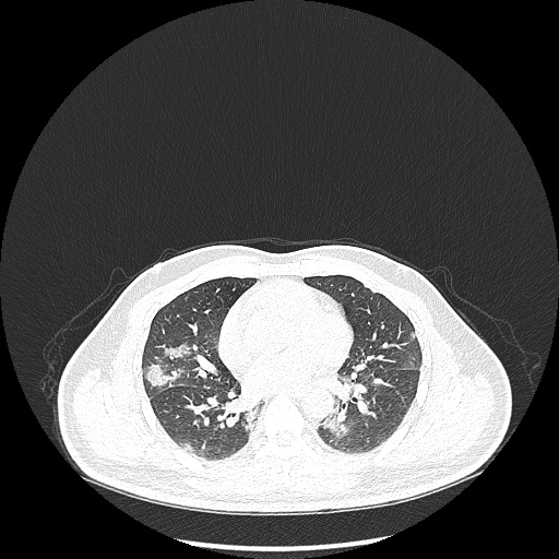 Acute appendicitis and COVID 19 pneumonia (Radiopaedia 76604-88380 Axial lung window 30).jpg