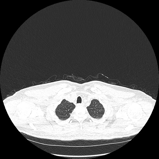 Acute appendicitis and COVID 19 pneumonia (Radiopaedia 76604-88380 Axial lung window 8).jpg