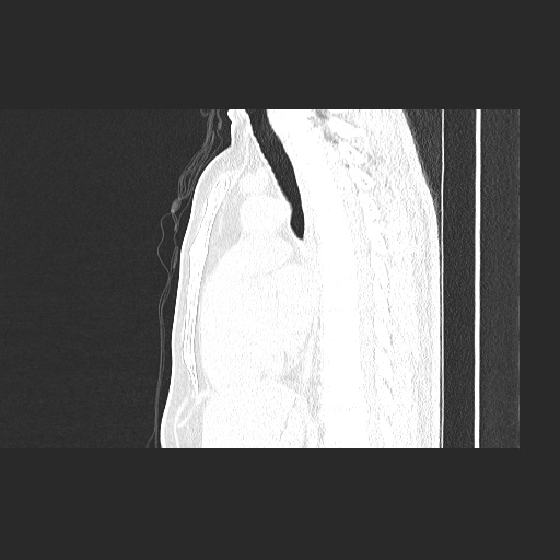 Acute appendicitis and COVID 19 pneumonia (Radiopaedia 76604-88380 Sagittal lung window 49).jpg
