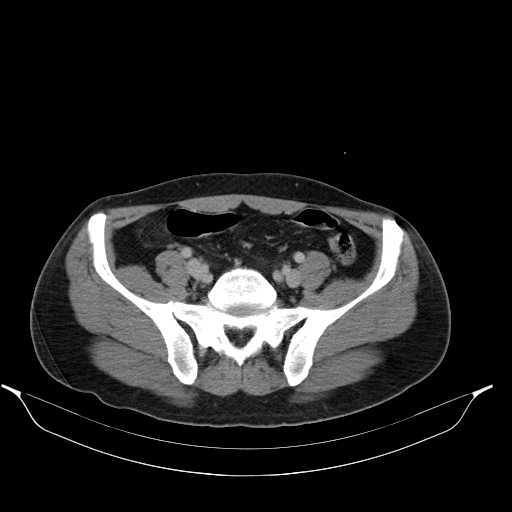 File:Acute appendicitis with appendicoliths (Radiopaedia 21148-21062 Axial C+ portal venous phase 15).jpg
